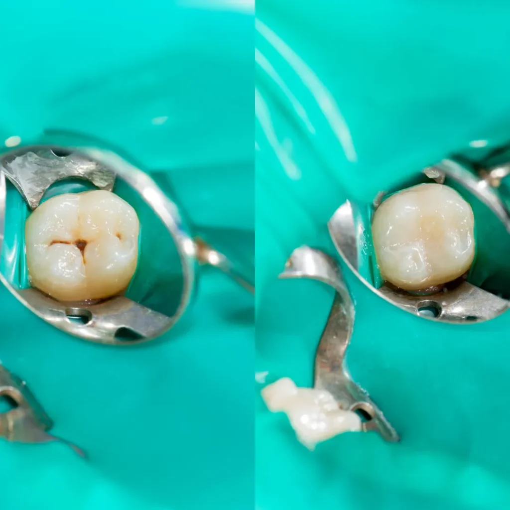 Comparing Dental Filling Materials