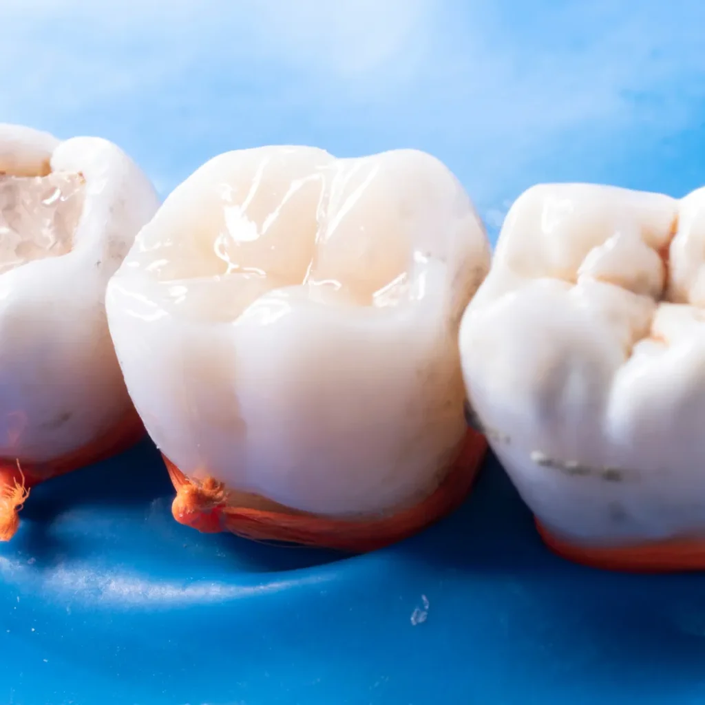What Are White Tooth Fillings