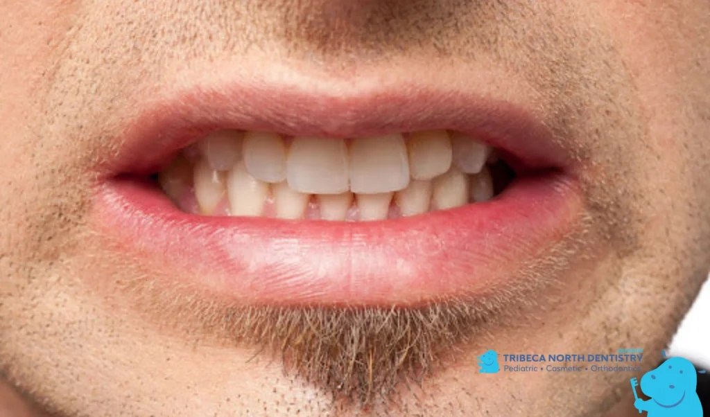 Habits That Can Contribute to Chipping