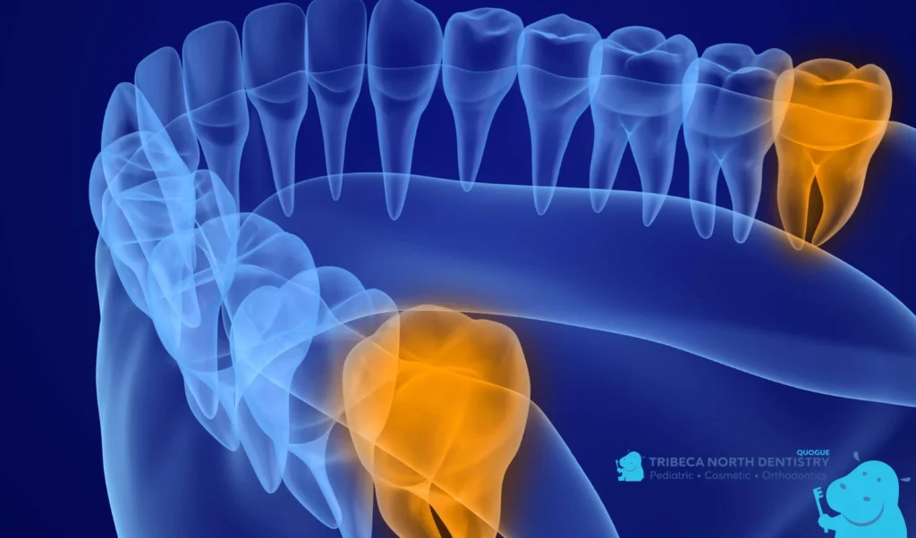 How Wisdom Teeth Are Different From Other Teeth