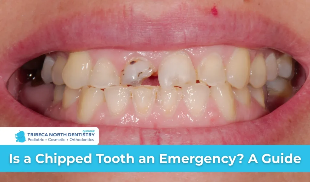 Is a Chipped Tooth an Emergency A Guide