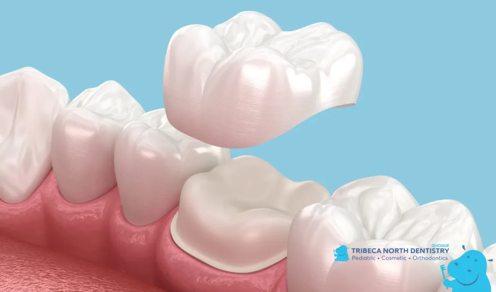 When to Consider Dental Crowns or Bonding